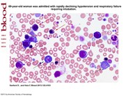 Value of the peripheral blood film: megakaryocytic fragments misidentified by automated counter