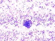 Metastatic Neuroblastoma - 1.