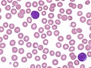 Lymphoblasts - 1.