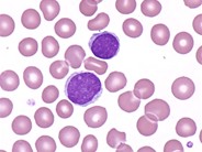 Lymphoblasts - 2.