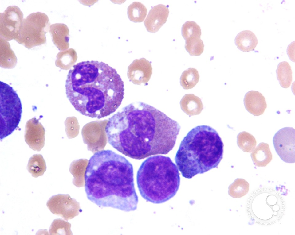 AML with inv(16) - 5.