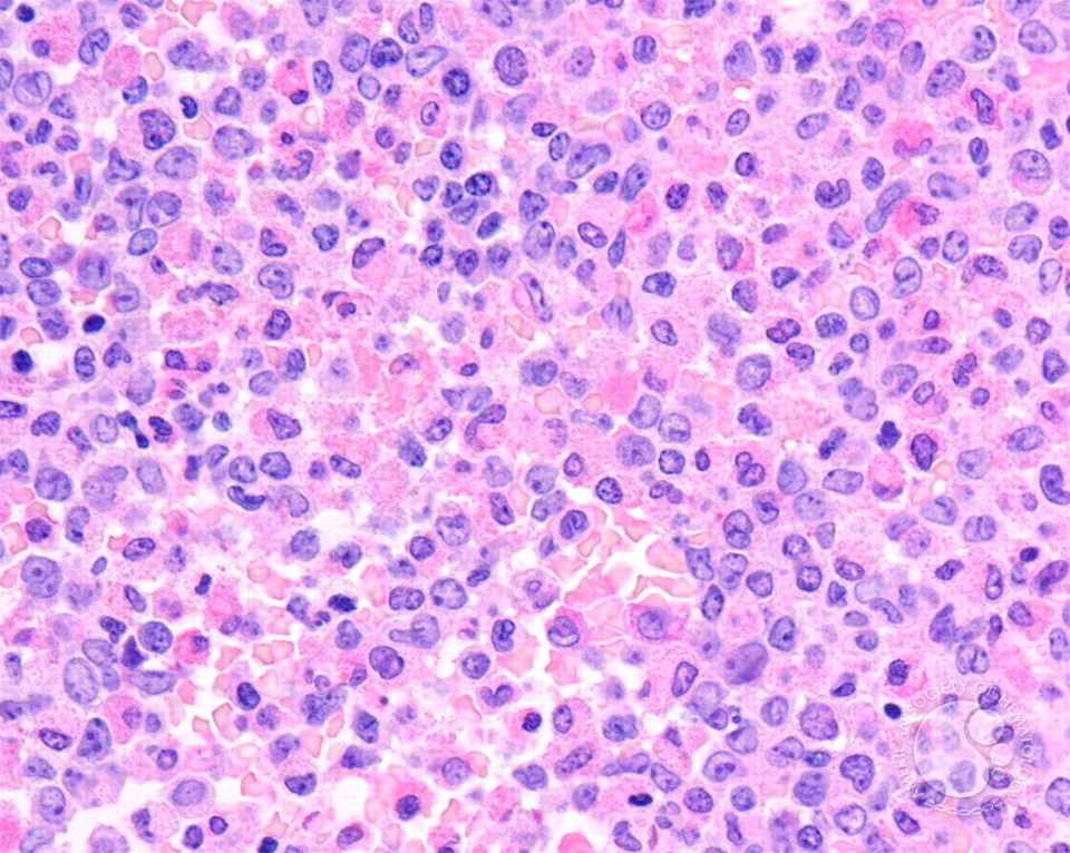 AML with inv(16) - 6.