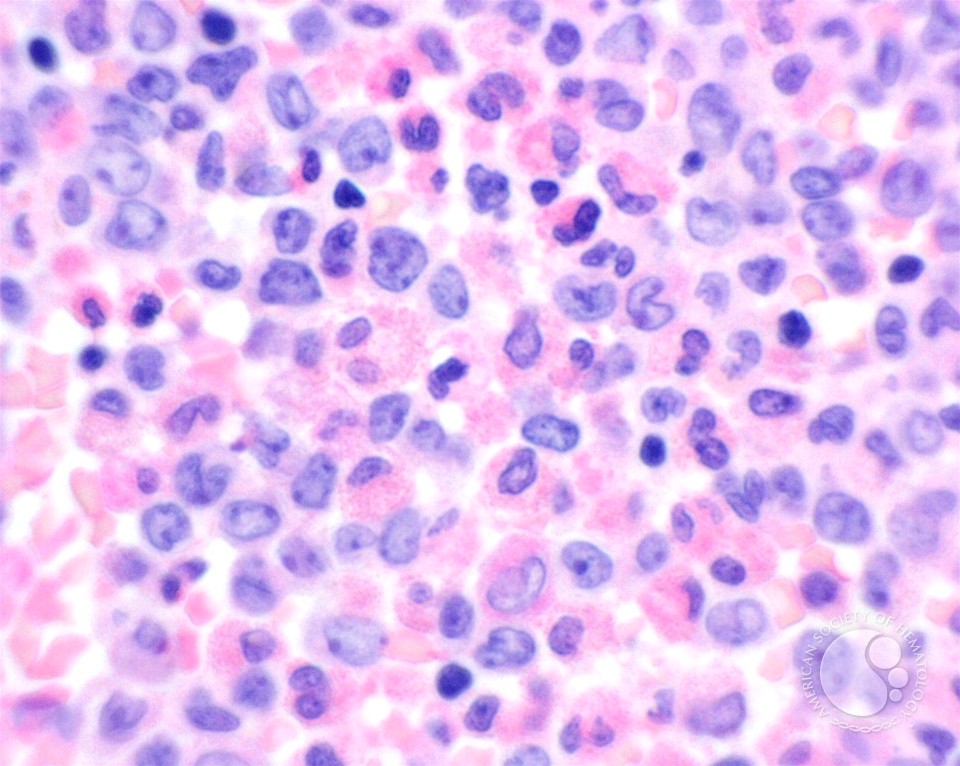AML with inv(16) - 7.