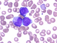 AML-M3, Hypogranular Variant - 2.