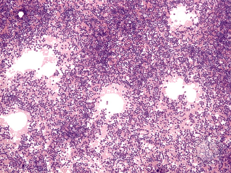 Precursor T-cell ALL - 5.