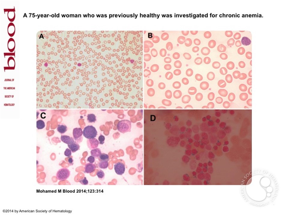 Refractory anemia with ring sideroblasts associated with thrombocytosis (RARS-T)