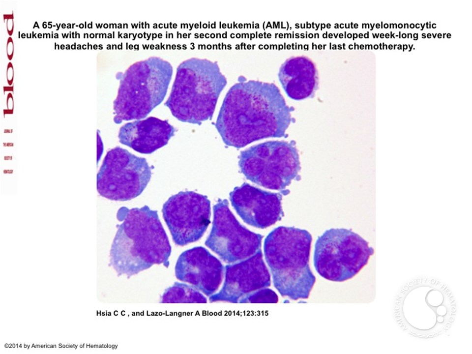 Acute myeloid leukemia relapse first presenting in the cerebrospinal fluid