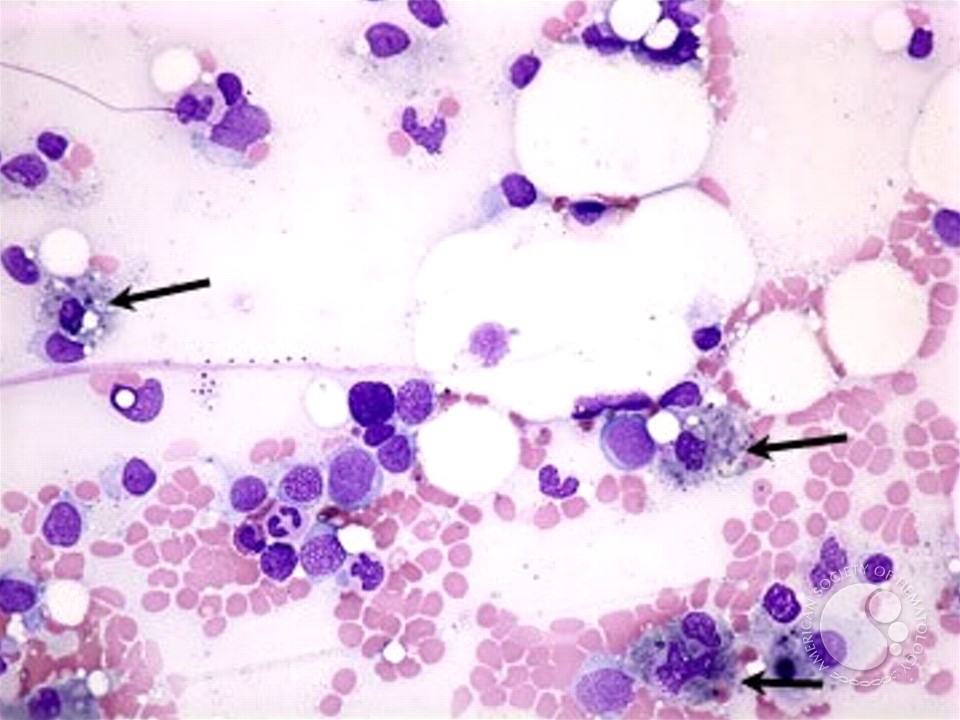Histiocytes - 1.
