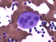 Dysplastic Megakaryocytes - 2.
