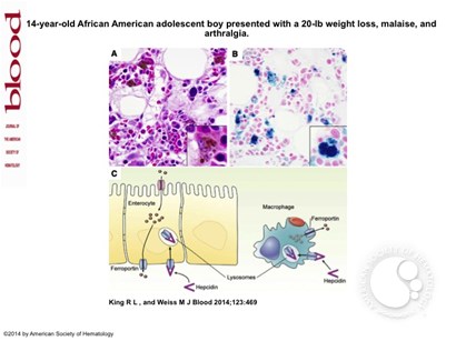 Iron-laden macrophage in autoimmune disease