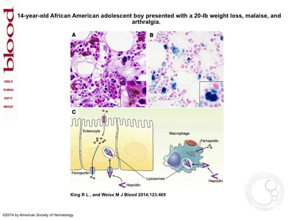 Iron-laden macrophage in autoimmune disease