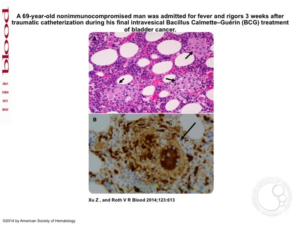 BCGitis induced inflammatory granuloma of the bone marrow