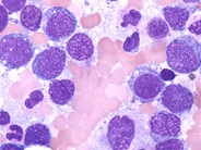 Pure Erythroid Leukemia - 1.