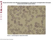 A double red cells population in a woman with a microcytic anemia