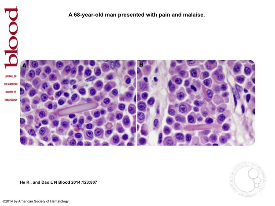 Extracellular and intracellular crystal deposition in plasma cell myeloma