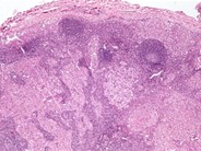 Langerhans Cell Histiocytosis - 1.