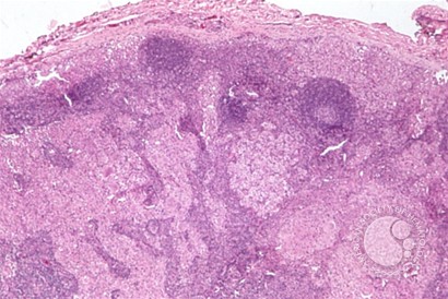 Langerhans Cell Histiocytosis - 1.
