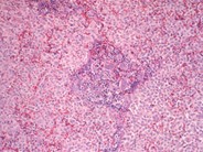 Langerhans Cell Histiocytosis - 2.