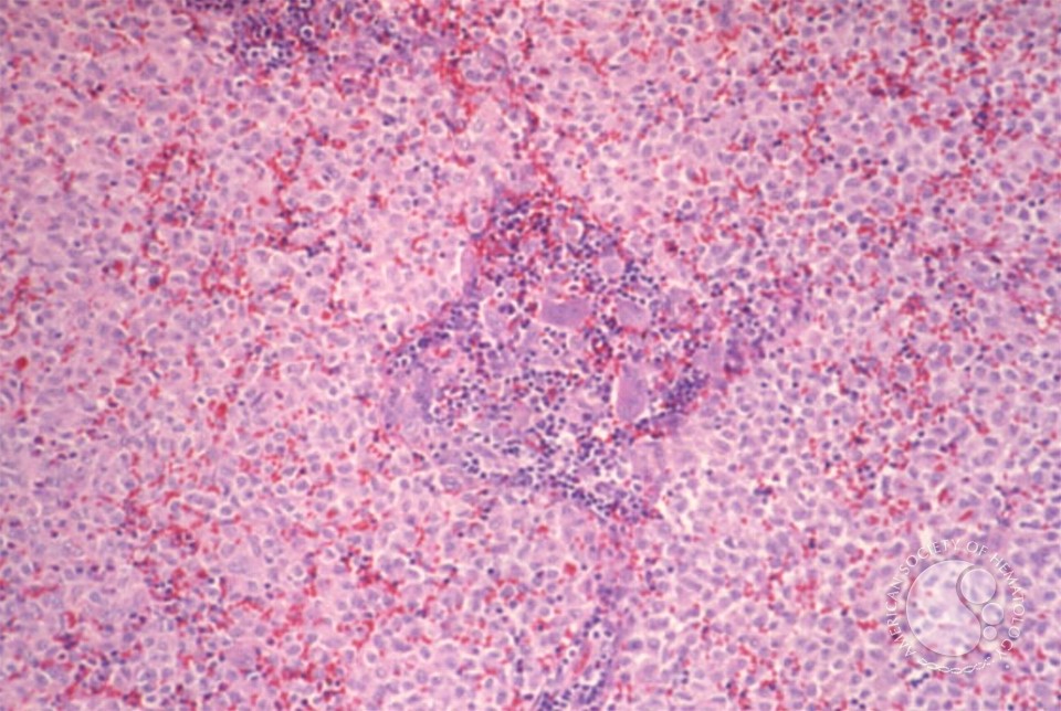 Langerhans Cell Histiocytosis - 2.