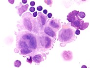 Langerhans Cell Histiocytosis - 3.