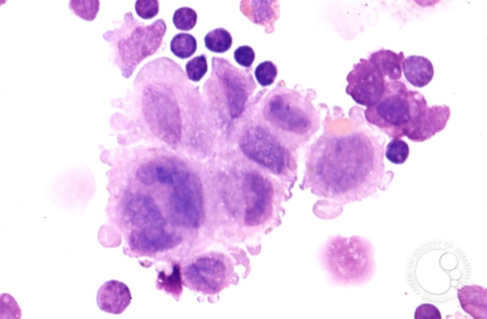 Langerhans Cell Histiocytosis - 3.