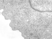 Langerhans Cell Histiocytosis - 5.