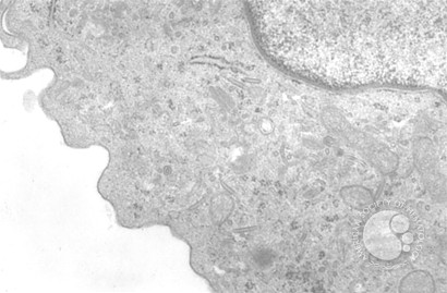 Langerhans Cell Histiocytosis - 5.
