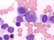 Refractory Anemia with Excess Blasts - 2.