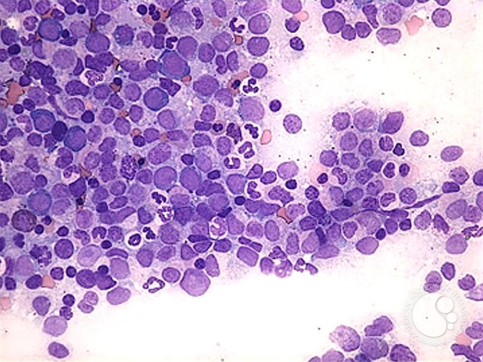 Refractory Anemia with Excess Blasts - 3.