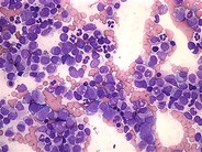 Refractory Anemia with Excess Blasts - 4.