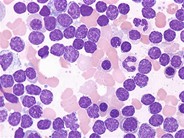 Chronic Lymphocytic Leukemia - 3.