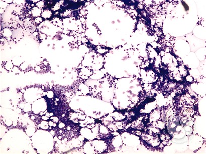 Hypocellular MDS - 2.