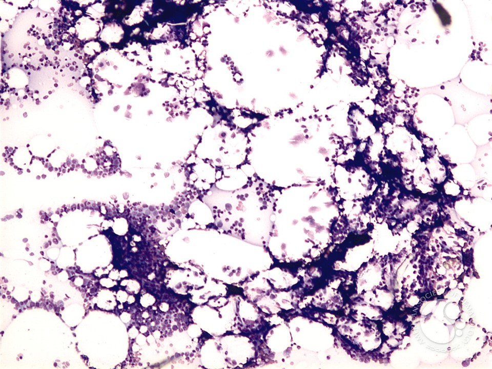 Hypocellular MDS - 2.