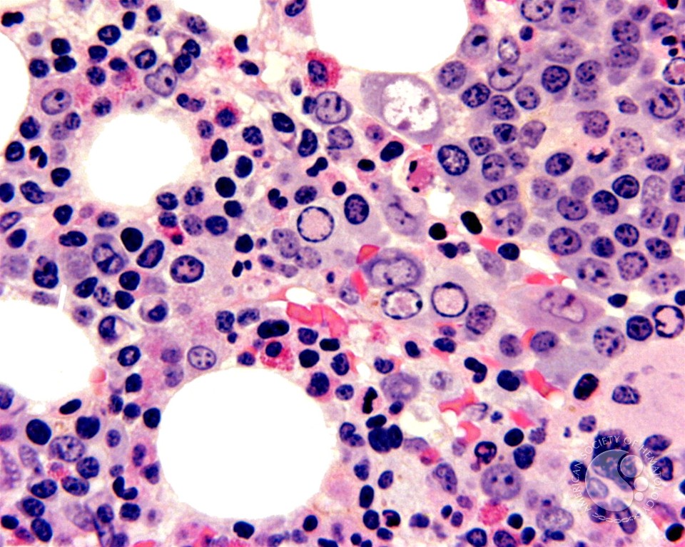 Parvovirus Inclusions - 4.