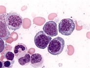Refractory Anemia with Ring Sideroblasts - 1.