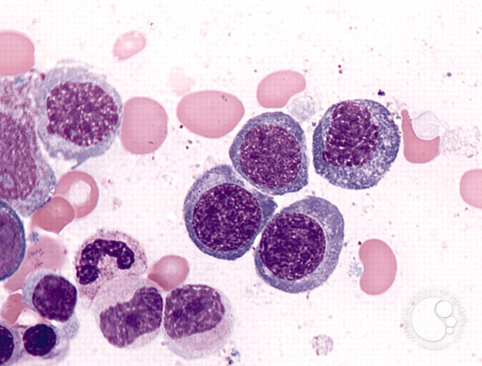 Refractory Anemia with Ring Sideroblasts - 1.