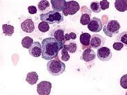 Refractory Anemia with Ring Sideroblasts - 2.