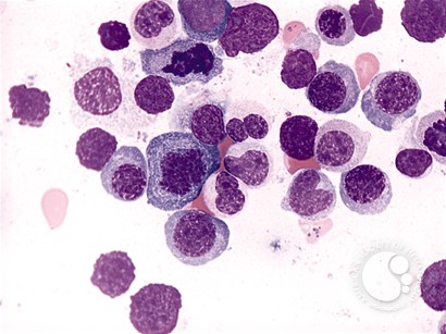 Refractory Anemia with Ring Sideroblasts - 2.