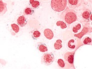 Refractory Anemia with Ring Sideroblasts - 3.