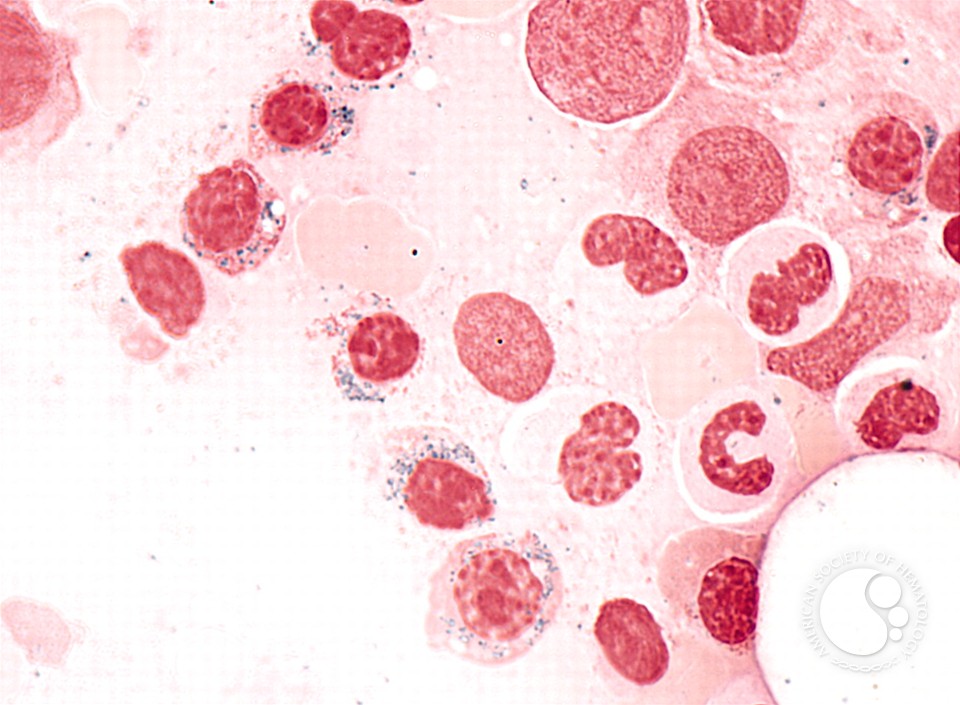 Refractory Anemia with Ring Sideroblasts - 3.
