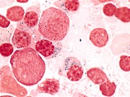 Refractory Anemia with Ring Sideroblasts - 4.