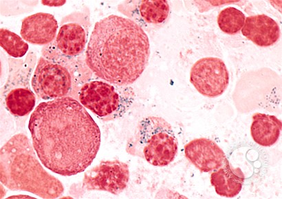 Refractory Anemia with Ring Sideroblasts - 4.