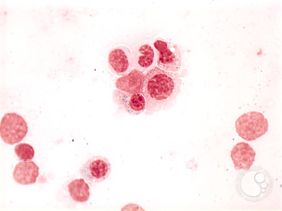 Refractory Anemia with Ring Sideroblasts - 5.