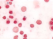 Refractory Anemia with Ring Sideroblasts - 6.