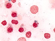 Refractory Anemia with Ring Sideroblasts - 7.