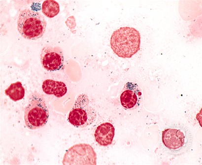 Refractory Anemia with Ring Sideroblasts - 7.
