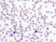 Spur Cell Anemia - 1.