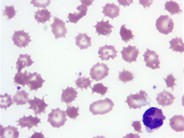 Spur Cell Anemia - 2.