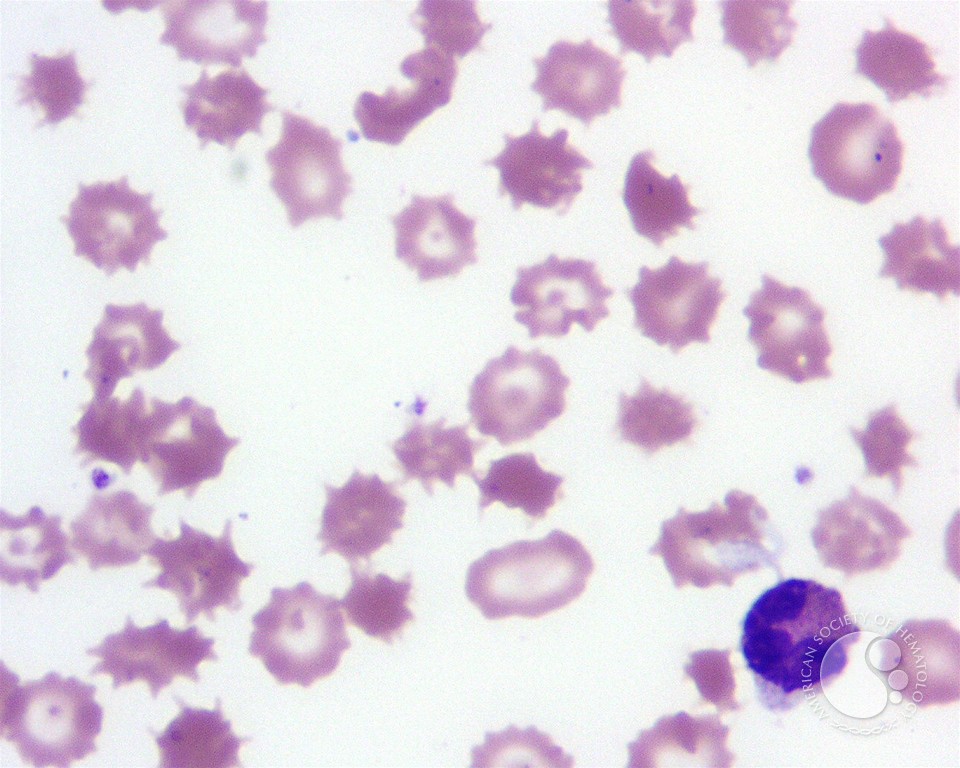 Spur Cell Anemia - 2.