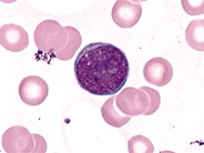Lymphoid Blast - 1.